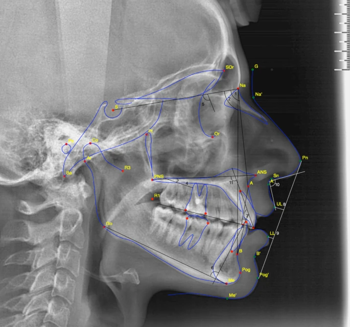 Cephalometric X-ray analysis for orthodontic evaluation