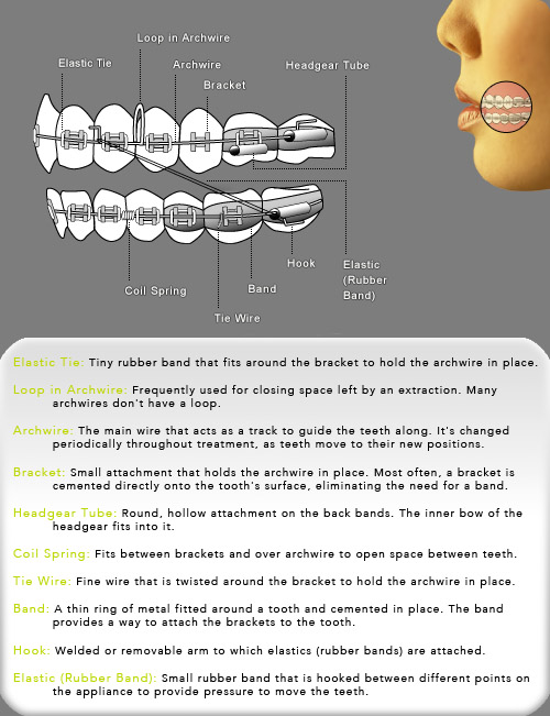braces diagram